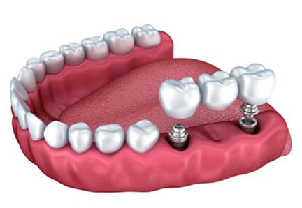 Dental Implant Fixed Prothesis